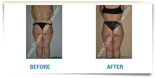 Before after pictures tummy tuck
