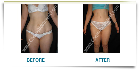 Tummy tuck before after woman
