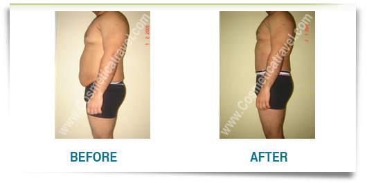 Tummy tuck before after man