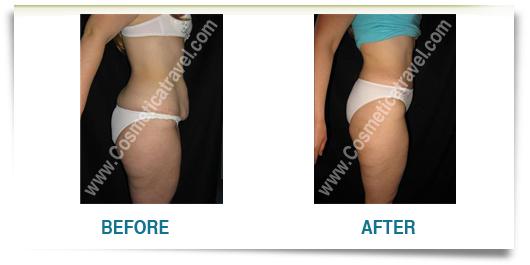 Before after pictures abdominoplasty