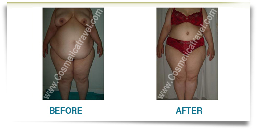 Abdominoplasty before after woman
