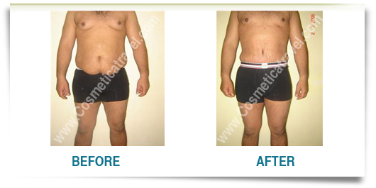 Abdominoplasty before after man