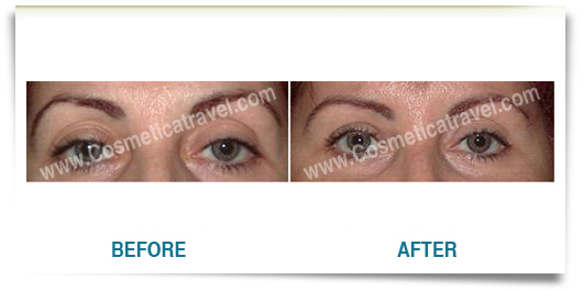 Before and after blepharoplasty photo