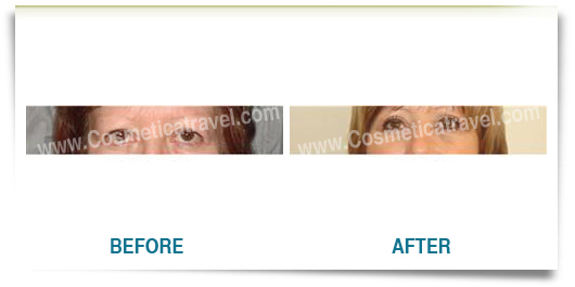 Eyelid surgery before after picture