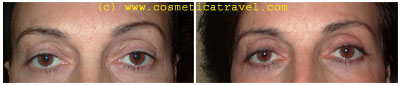 Blepharoplasty before after picture