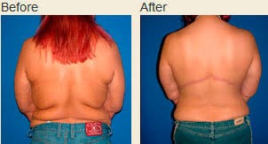 Photos before and after a body lift surgery