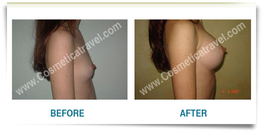 Breast augmentation before after picture