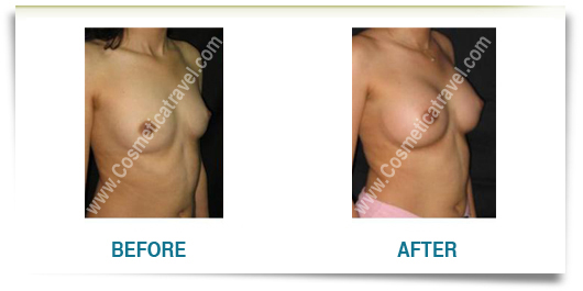 Before after picture breast implants 