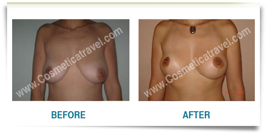 Before after picture breast uplift