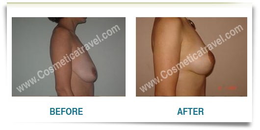 Breast uplift before after