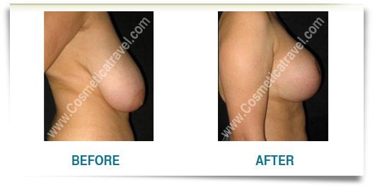Breast reduction before after picture
