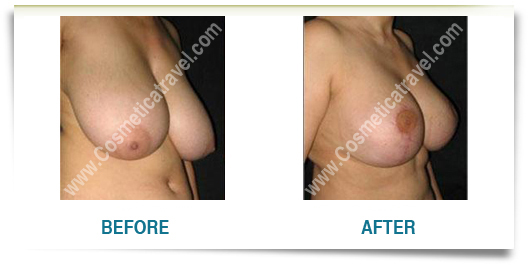 Breast reduction picture