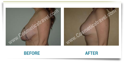 Breast reduction surgery  before after