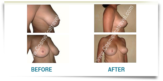 Before after picture breast size reduction 
