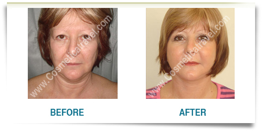 Facelift before after picture