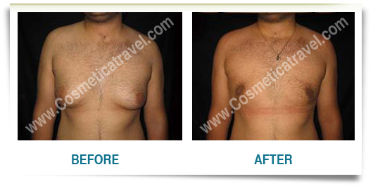 Gynecomastia before after