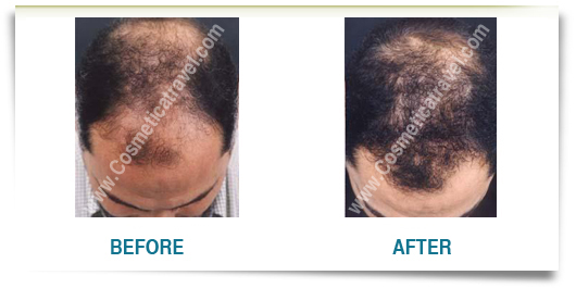 Man hair transplant before after picture
