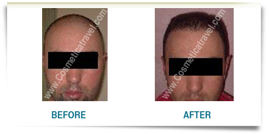 Hair transplants picture before after