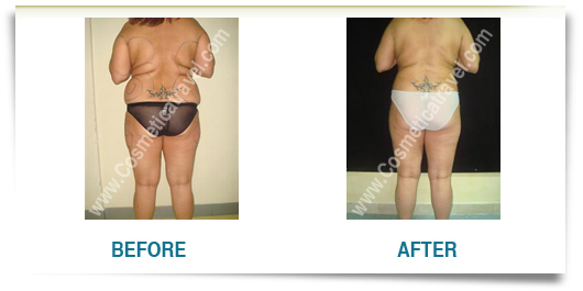 Before after liposuction picture woman