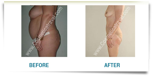 Picture of liposuction before after