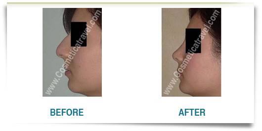 Before after picture rhinoplasty