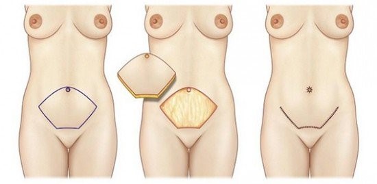 Abdominoplasty surgery