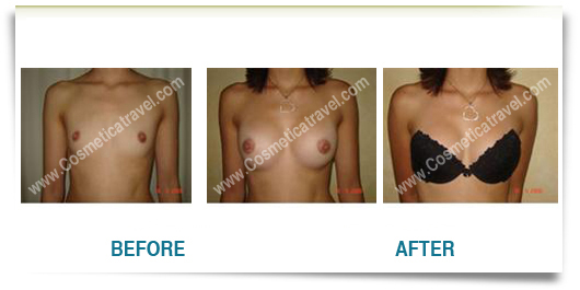 Jumella Empire - Natural Breast Enlargment procedure