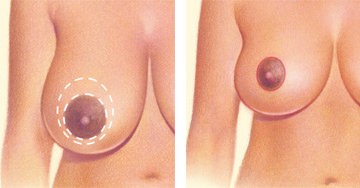 A circular pattern around the areola