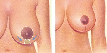 A keyhole  or racquet-shaped pattern with an incision around the areola and vertically  down to the breast crease