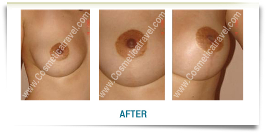 Before after picture breast ptosis