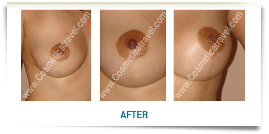 Breast uplift surgery Tunisia, Mastopexy - CosmeticaTravel