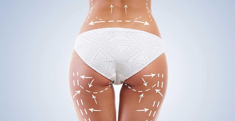 Bum plastic surgery Tunisia, Bum enlargement - CosmeticaTravel