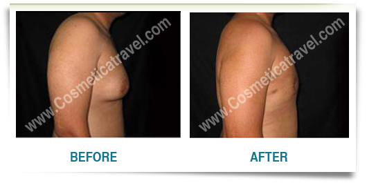 Before after picture gynecomastia