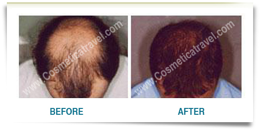 Hair transplant before after