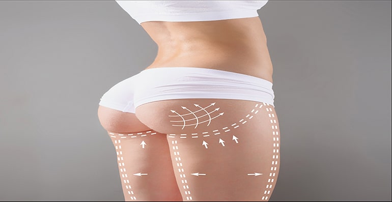 Hip Filling Shapewear Tighten Thigh Liposuction Medical