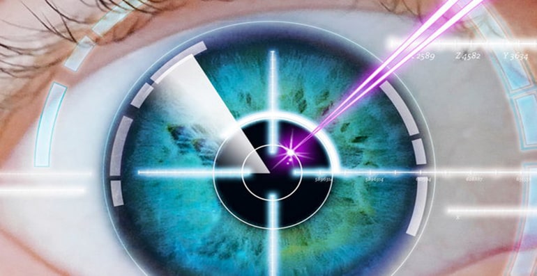 Laser Myopia (Classic Lasik)