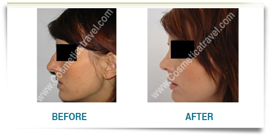 Rhinoplasty Photo