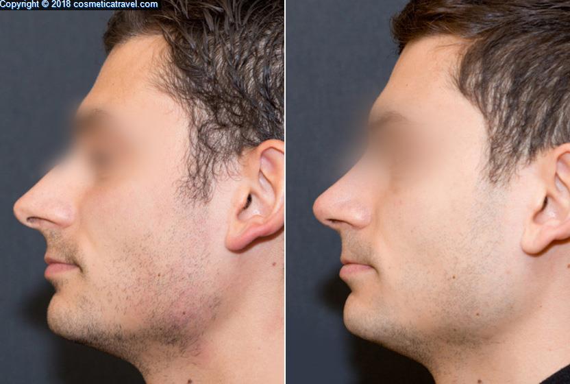 Rhinoplasty before after